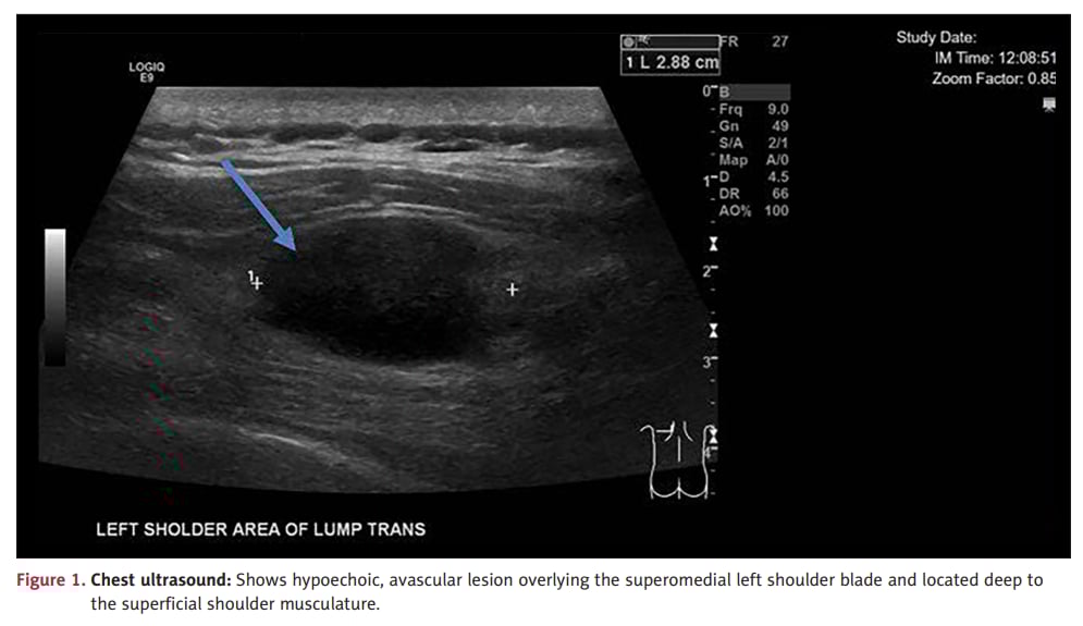 上皮样血管肉瘤疑似神经鞘瘤患者胸部超声表现