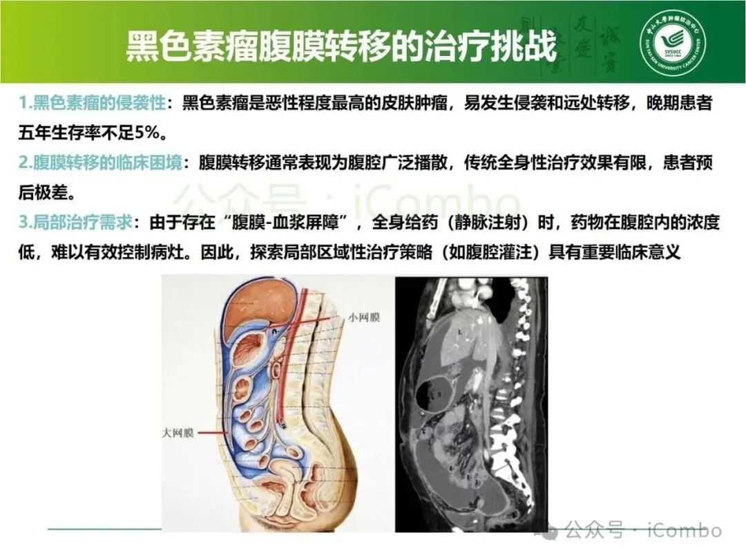 免疫检查点抑制剂联合动脉灌注治疗黑色素瘤腹膜转移资料图