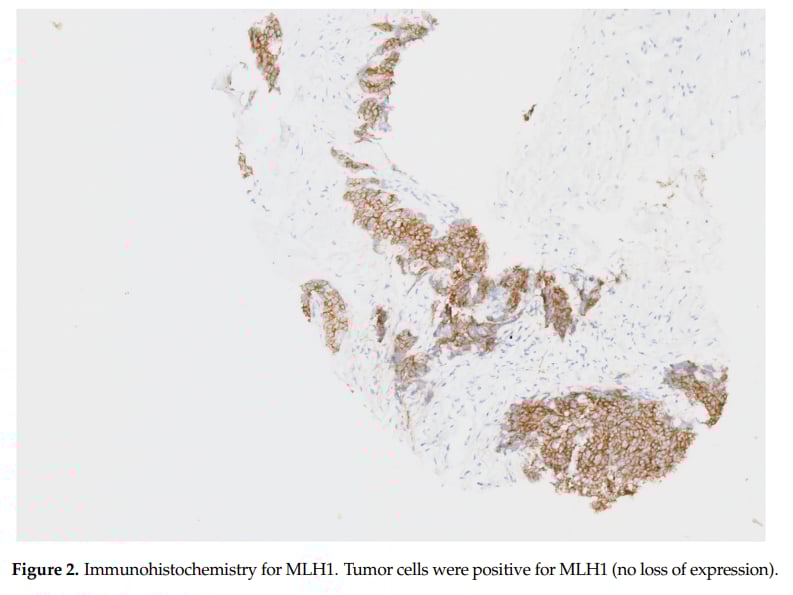 MLH1免疫组化染色结果用于评估胸腺瘤分子特征