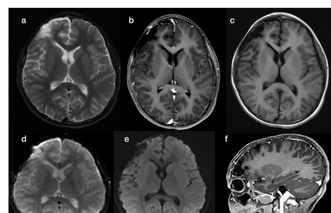 阿来替尼维持治疗6个月后颅脑多序列随访MRI