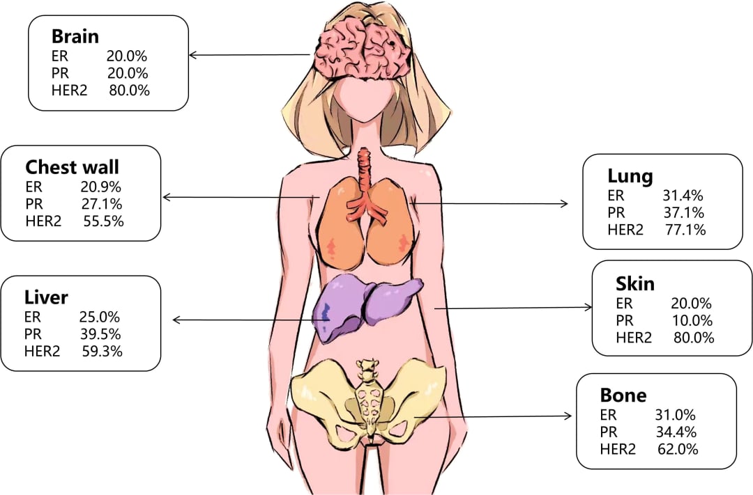 乳腺癌肝、肺、骨转移病灶受体异质性