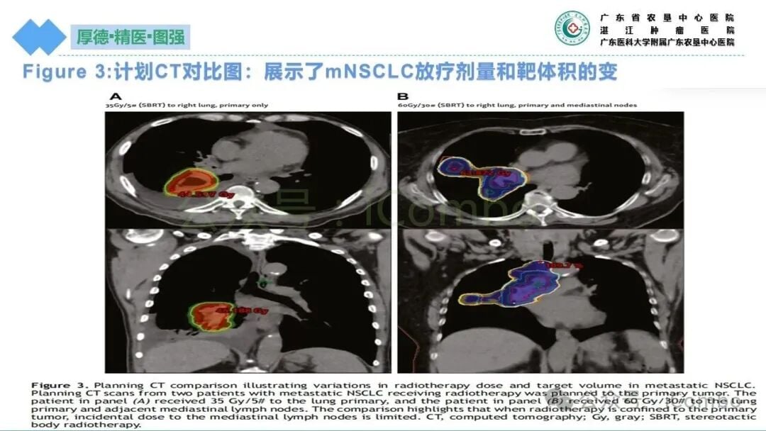 放疗联合靶向与免疫治疗的相互作用机制