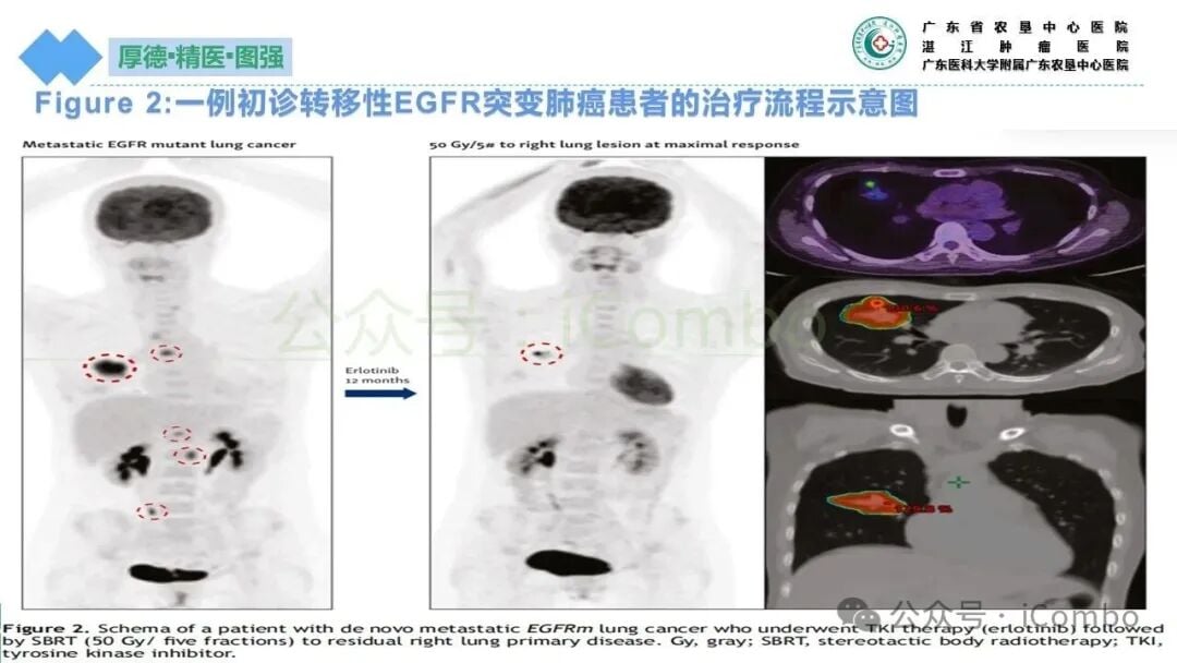 原发灶局部根治对延缓转移与耐药的生物学机制