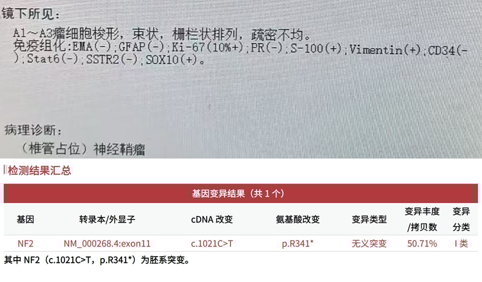 NF2/SMARCB1/LZTR1基因检测:揭示神经鞘瘤的遗传奥秘与诊断关键 2 神经鞘瘤患者检出NF2基因胚系有害变异