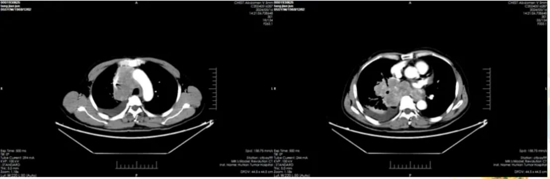 替尼泊苷治疗肺大细胞神经内分泌癌脑转移效果显著:一例成功病例深度解析 1 治疗前肺部影像