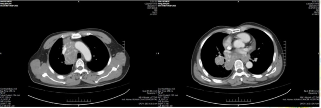替尼泊苷治疗肺大细胞神经内分泌癌脑转移效果显著:一例成功病例深度解析 2 治疗后肺部影像