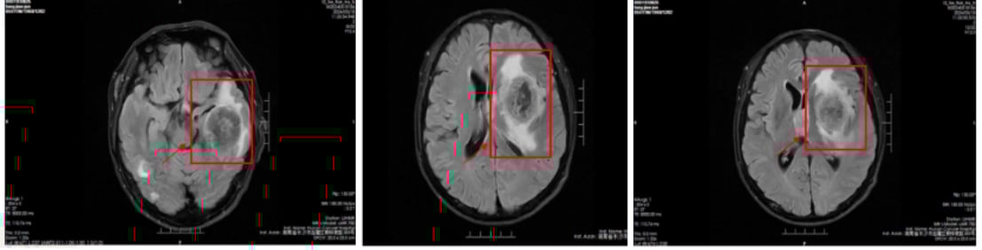替尼泊苷治疗肺大细胞神经内分泌癌脑转移效果显著:一例成功病例深度解析 3 治疗前头部影像