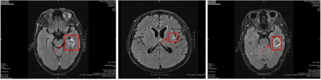 替尼泊苷治疗肺大细胞神经内分泌癌脑转移效果显著:一例成功病例深度解析 4 治疗后头部影像