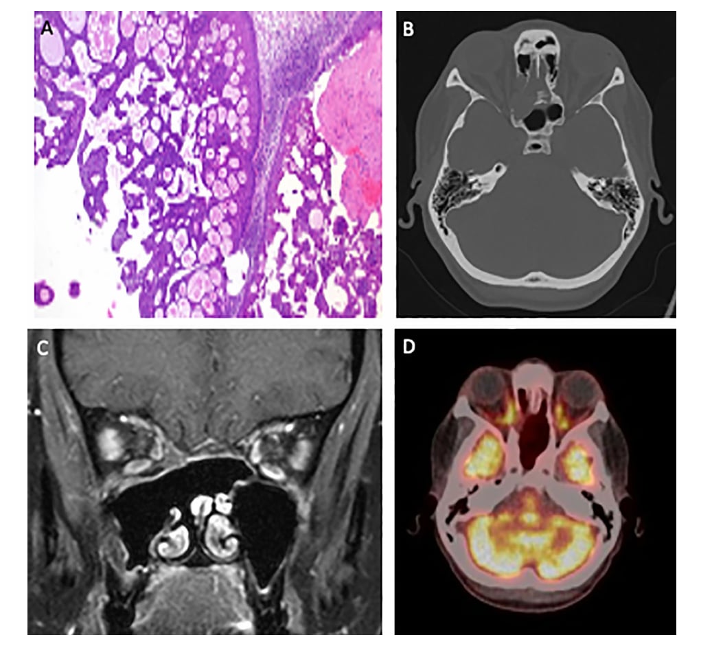 DEK::AFF2融合鼻旁窦癌新突破:顺铂联合吉西他滨化疗方案带来治愈希望 3 1752115815663_6512445.png