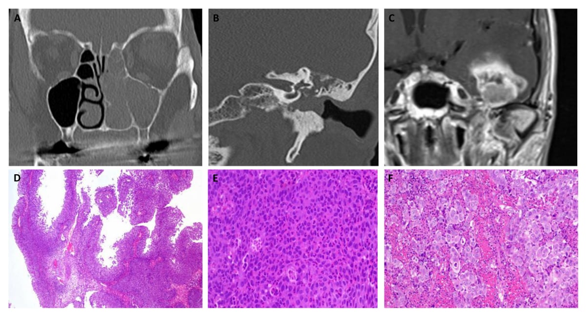 DEK::AFF2融合鼻旁窦癌新突破:顺铂联合吉西他滨化疗方案带来治愈希望 4 1752115831985_6512445.png
