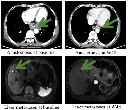晚期胃癌治疗新希望:IMC002 CAR-T疗法突破性进展,66.7%缓解率与卓越安全性解析 1 1768878365638_8538692.png