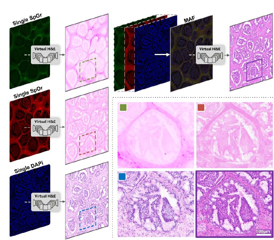 乳腺癌病理诊断提速:AI虚拟H&E染色几分钟出结果靠谱吗 4 乳腺癌虚拟H&E单通道与多光谱融合图像质量对比