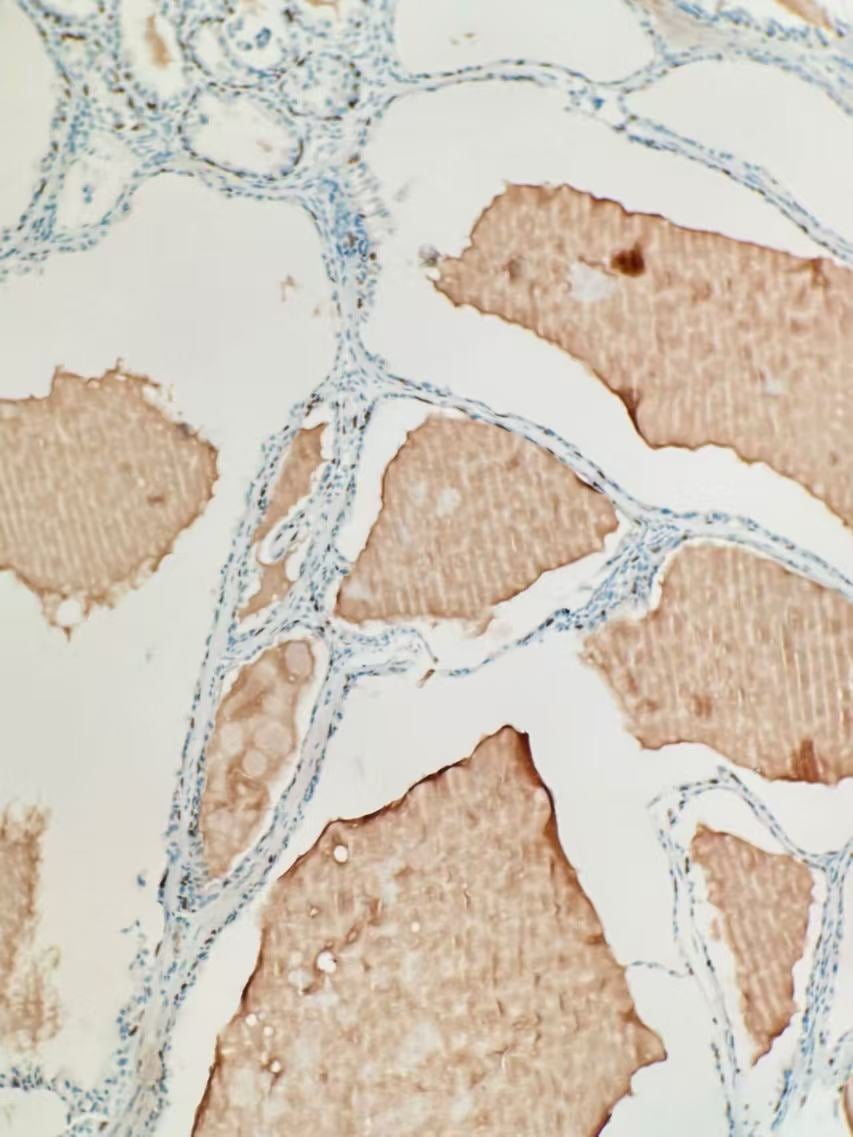 深入解析罕见乳腺癌:囊性高分泌性癌(CHC)的诊断、治疗与靶向药选择 4 图片
