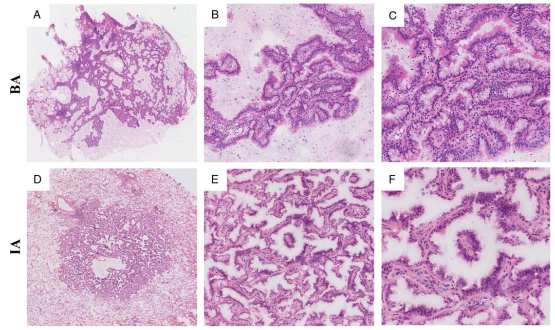 深入解析肺浸润性黏液腺癌:临床病理、分子特征与靶向治疗新进展 5 图片