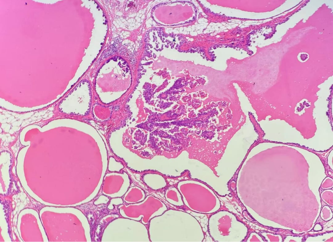 深入解析罕见乳腺癌:囊性高分泌性癌(CHC)的诊断、治疗与靶向药选择 1 图片