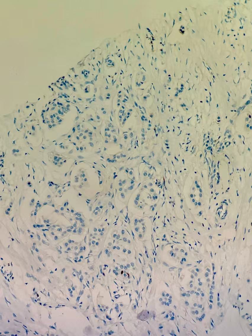 深入解析罕见乳腺癌:囊性高分泌性癌(CHC)的诊断、治疗与靶向药选择 5 图片