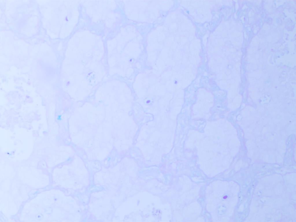 罕见肺癌病例:非小细胞肺癌腺鳞双向分化,TTF1与p40共表达的诊疗挑战与靶向药探索 9 图片