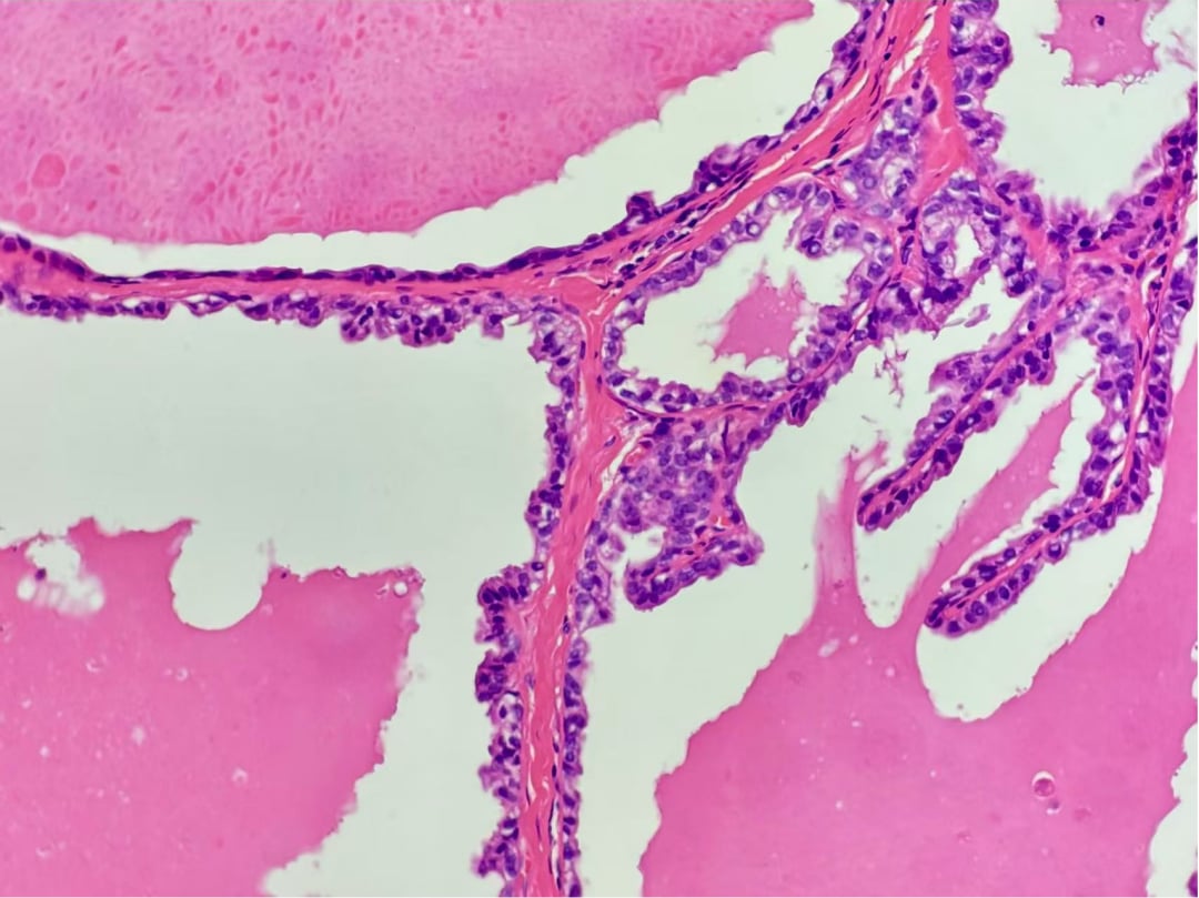 深入解析罕见乳腺癌:囊性高分泌性癌(CHC)的诊断、治疗与靶向药选择 2 图片