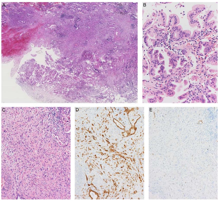 深入解析肺浸润性黏液腺癌:临床病理、分子特征与靶向治疗新进展 1 图片