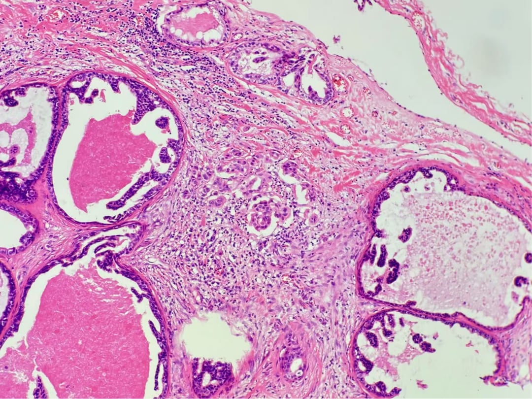 深入解析罕见乳腺癌:囊性高分泌性癌(CHC)的诊断、治疗与靶向药选择 3 图片