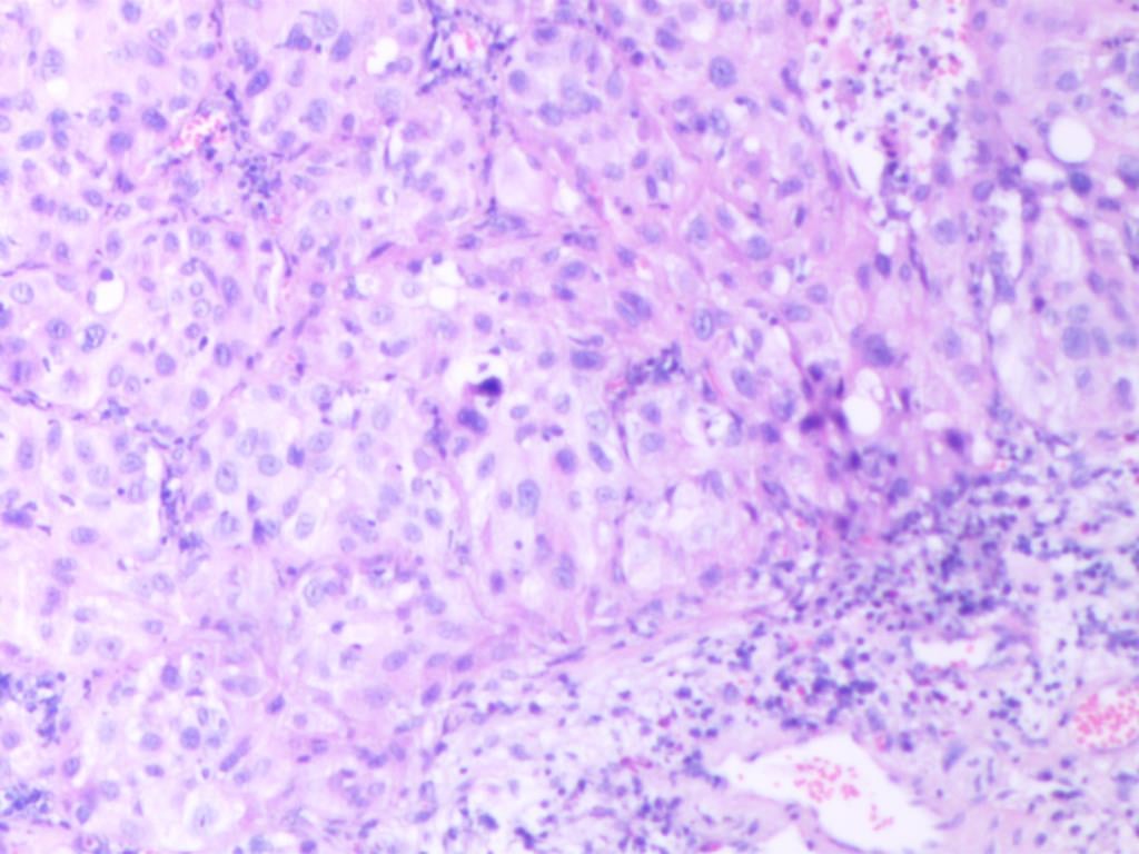 罕见肺癌病例:非小细胞肺癌腺鳞双向分化,TTF1与p40共表达的诊疗挑战与靶向药探索 1 图片