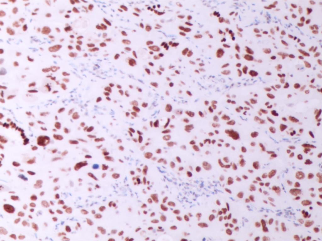 罕见肺癌病例:非小细胞肺癌腺鳞双向分化,TTF1与p40共表达的诊疗挑战与靶向药探索 7 图片