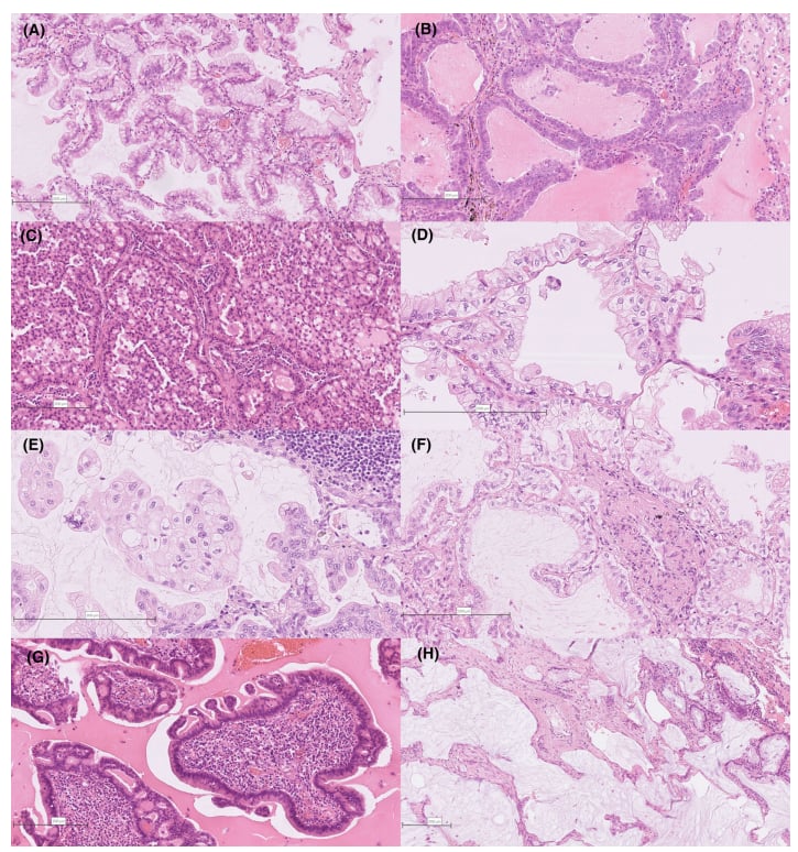 深入解析肺浸润性黏液腺癌:临床病理、分子特征与靶向治疗新进展 2 图片