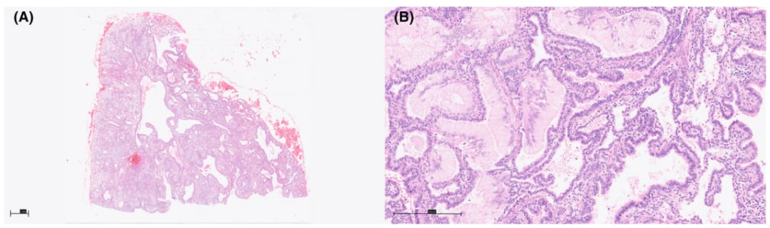 深入解析肺浸润性黏液腺癌:临床病理、分子特征与靶向治疗新进展 4 图片