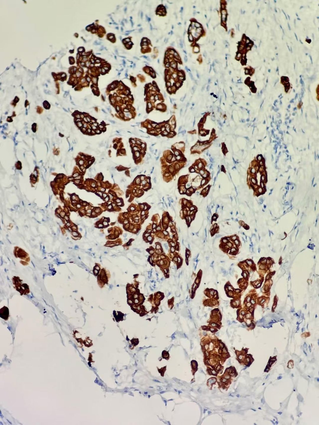 深入解析罕见乳腺癌:囊性高分泌性癌(CHC)的诊断、治疗与靶向药选择 6 图片