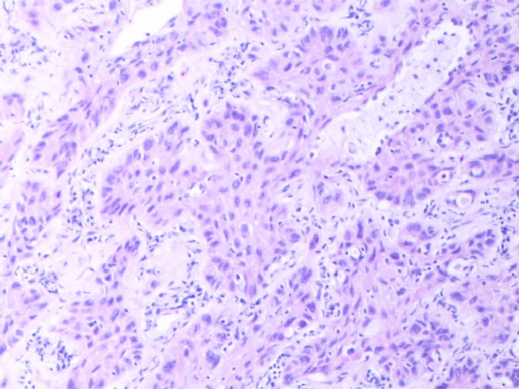 罕见肺癌病例:非小细胞肺癌腺鳞双向分化,TTF1与p40共表达的诊疗挑战与靶向药探索 3 图片