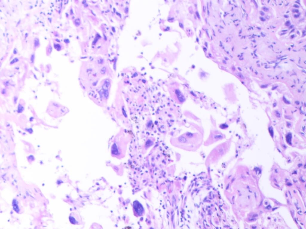 罕见肺癌病例:非小细胞肺癌腺鳞双向分化,TTF1与p40共表达的诊疗挑战与靶向药探索 4 图片