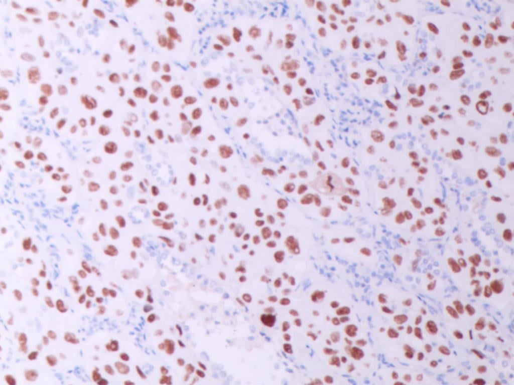 罕见肺癌病例:非小细胞肺癌腺鳞双向分化,TTF1与p40共表达的诊疗挑战与靶向药探索 6 图片