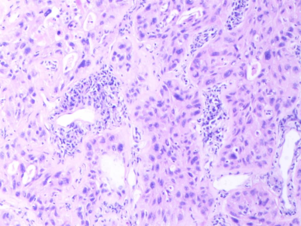 罕见肺癌病例:非小细胞肺癌腺鳞双向分化,TTF1与p40共表达的诊疗挑战与靶向药探索 2 图片