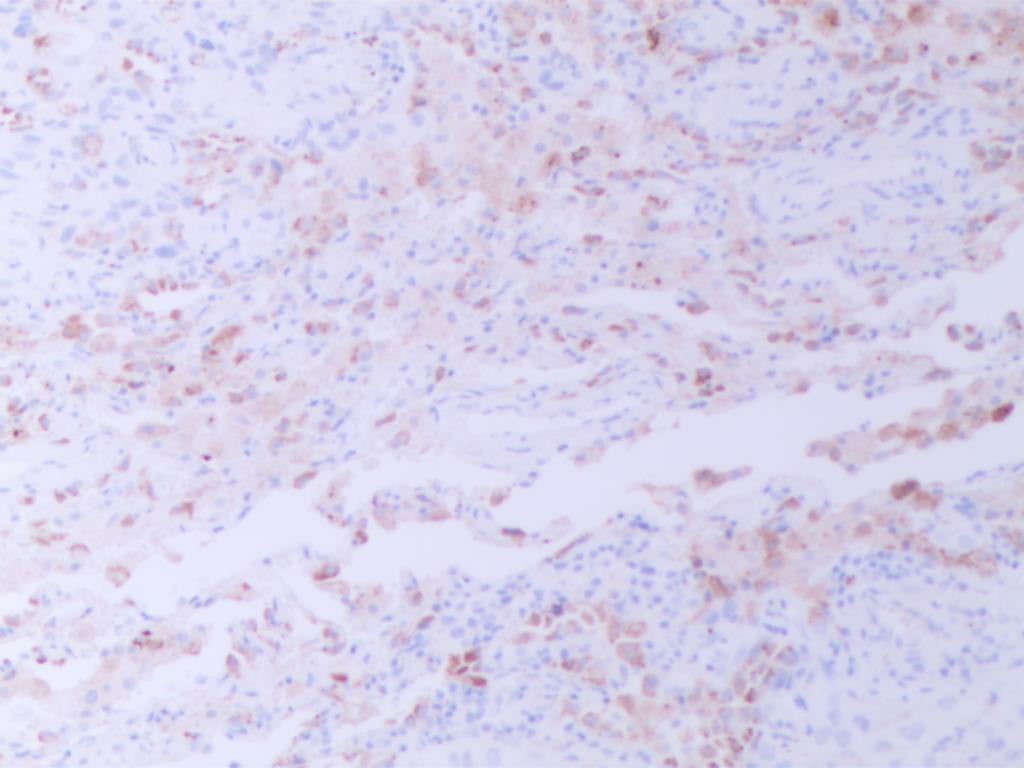 罕见肺癌病例:非小细胞肺癌腺鳞双向分化,TTF1与p40共表达的诊疗挑战与靶向药探索 8 图片