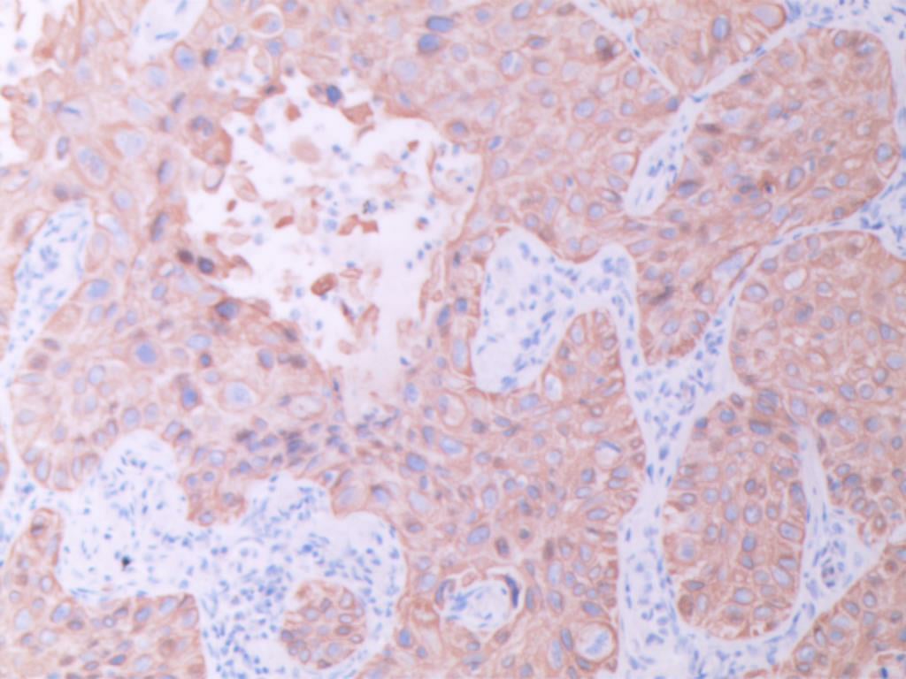 罕见肺癌病例:非小细胞肺癌腺鳞双向分化,TTF1与p40共表达的诊疗挑战与靶向药探索 5 图片