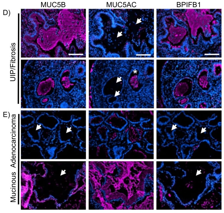 深入解析肺浸润性黏液腺癌:临床病理、分子特征与靶向治疗新进展 6 图片