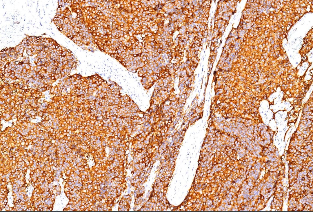 深度解读宫颈小细胞神经内分泌癌:从病例看诊断与治疗前景 4 肿瘤细胞Syn阳性