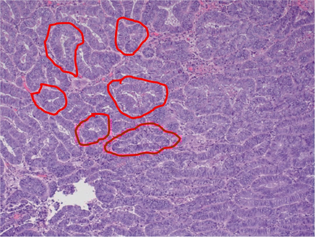 看懂子宫内膜样癌病理报告:FIGO分级与关键基因(PTEN/TP53/MMR)深度解析 1 密集的腺管