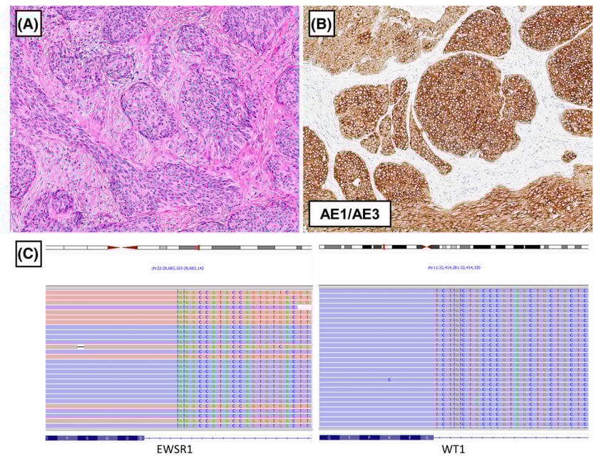 罕见胸膜肿瘤深度解读:一文看懂各类间叶源性肿瘤的病理与基因特征 6 图片