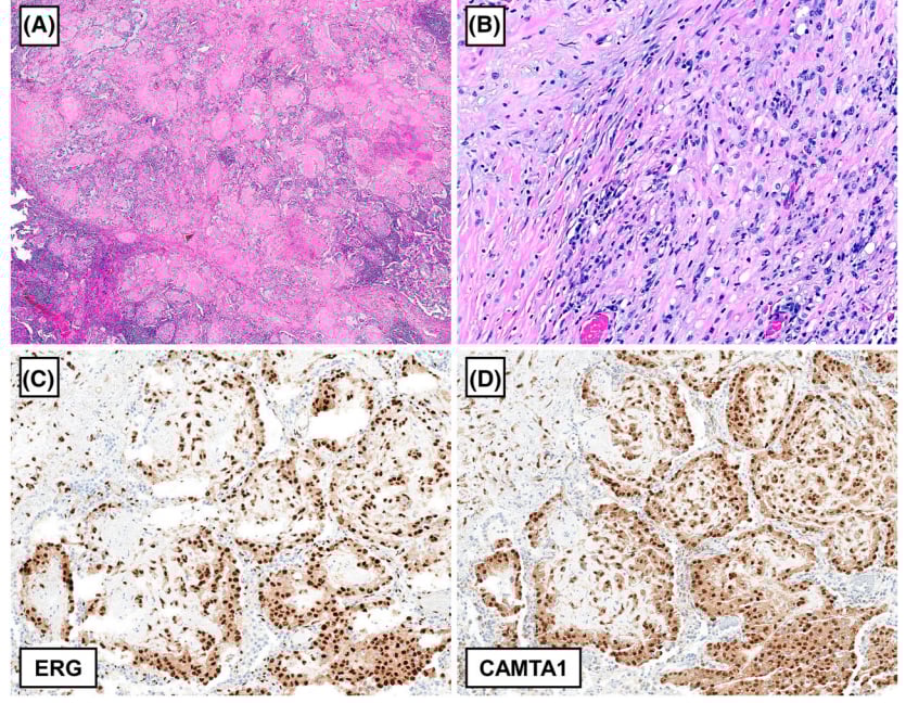 罕见胸膜肿瘤深度解读:一文看懂各类间叶源性肿瘤的病理与基因特征 5 图片