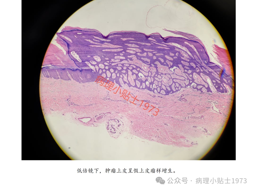 脚底长了结节是癌症吗?一文了解小汗腺汗管纤维腺瘤的诊断与治疗 9 图片