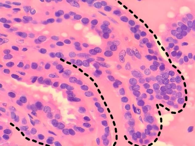甲状腺滤泡结节性病变是癌吗?一文读懂病理报告与甲状腺癌的区别 4 图片