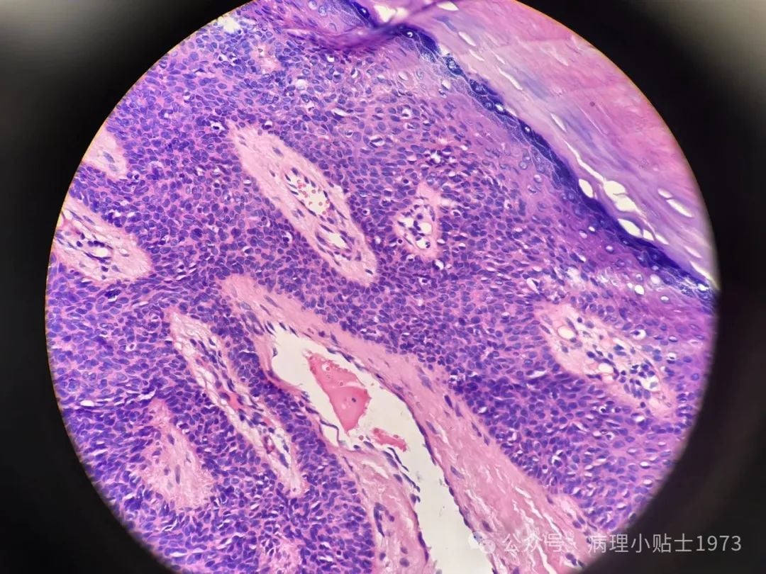 脚底长了结节是癌症吗?一文了解小汗腺汗管纤维腺瘤的诊断与治疗 5 图片