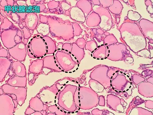 甲状腺滤泡结节性病变是癌吗?一文读懂病理报告与甲状腺癌的区别 2 image.png