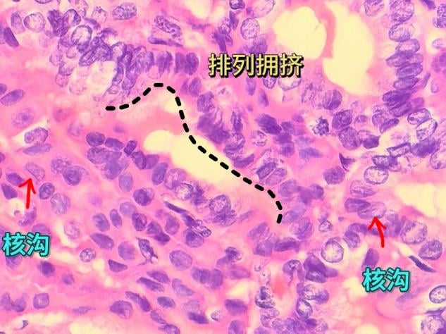 甲状腺滤泡结节性病变是癌吗?一文读懂病理报告与甲状腺癌的区别 5 图片