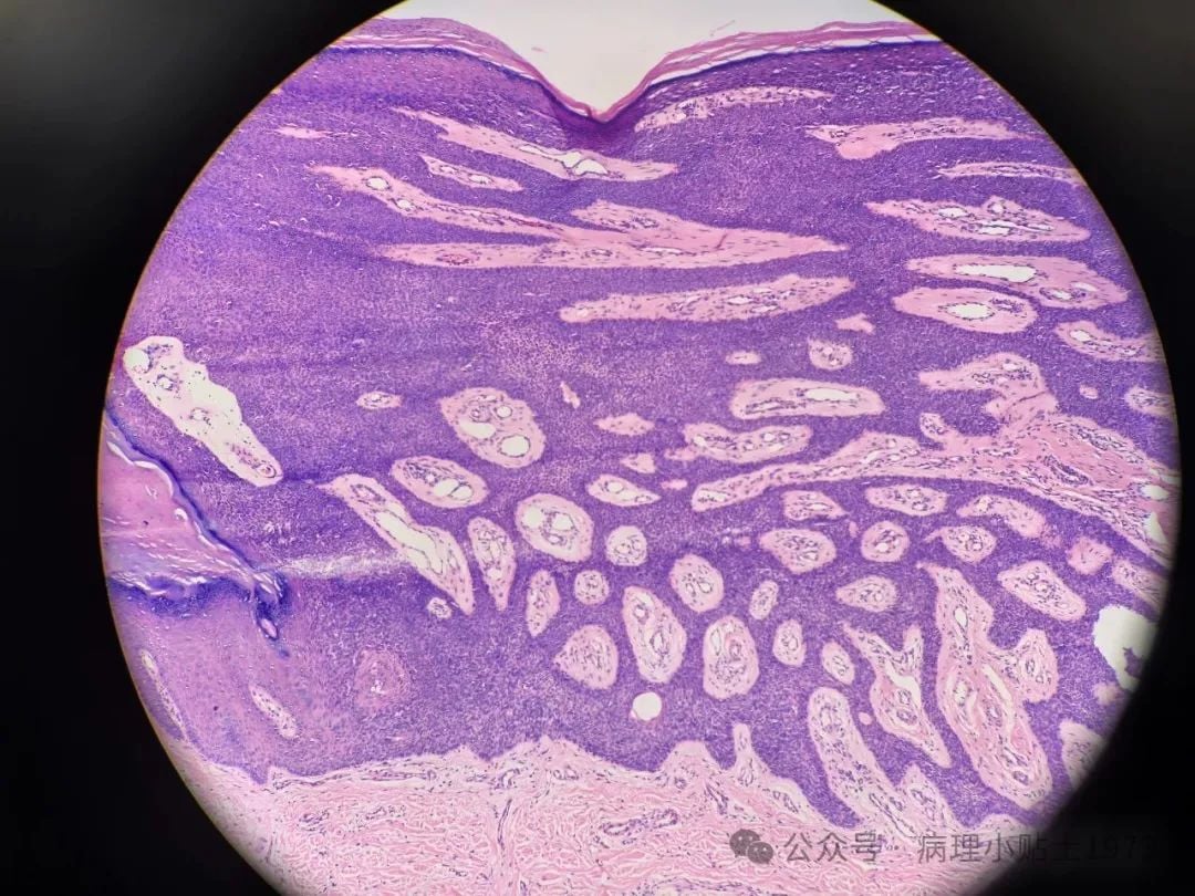 脚底长了结节是癌症吗?一文了解小汗腺汗管纤维腺瘤的诊断与治疗 2 图片