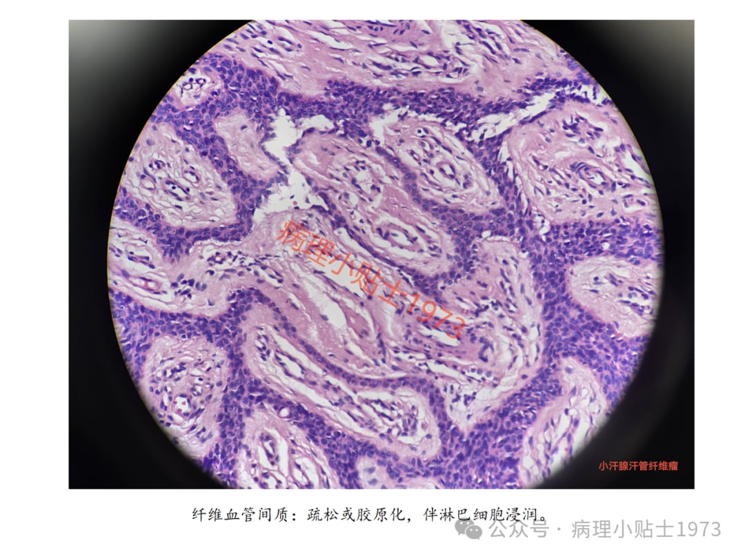 脚底长了结节是癌症吗?一文了解小汗腺汗管纤维腺瘤的诊断与治疗 15 图片