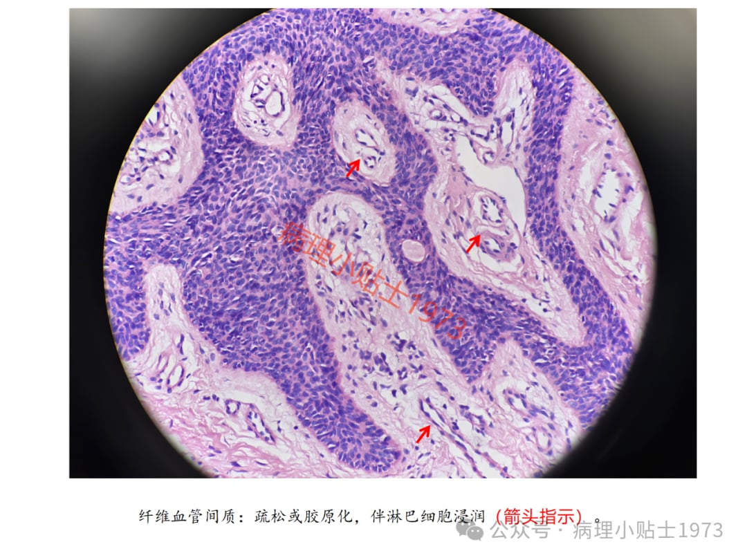 脚底长了结节是癌症吗?一文了解小汗腺汗管纤维腺瘤的诊断与治疗 14 图片