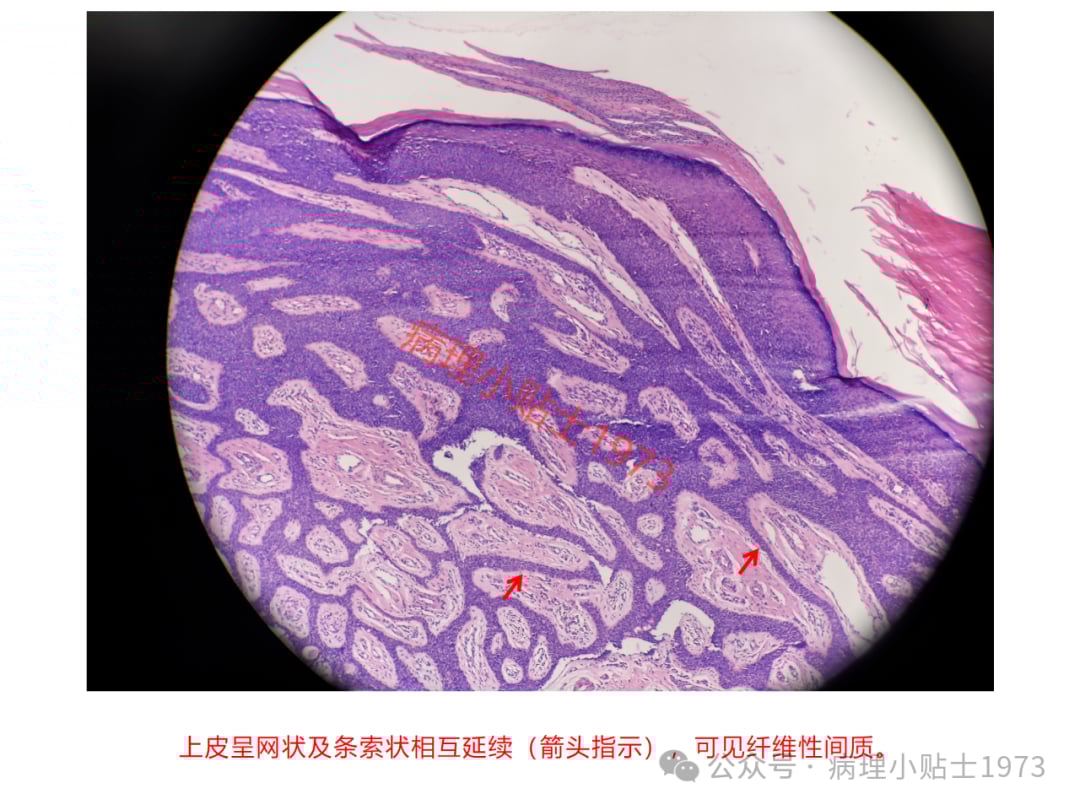 脚底长了结节是癌症吗?一文了解小汗腺汗管纤维腺瘤的诊断与治疗 11 图片