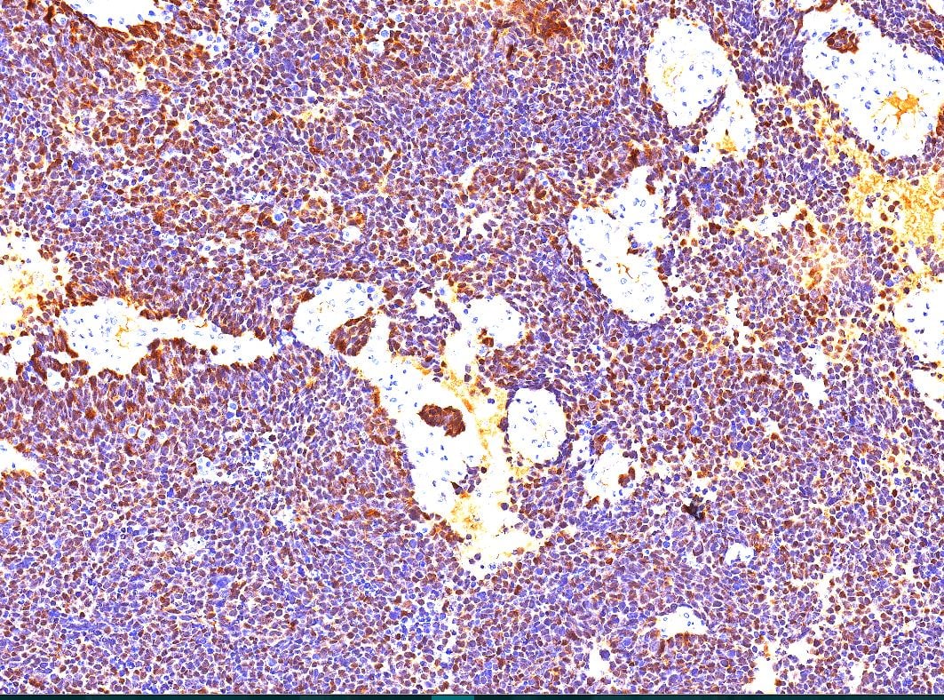 深度解读宫颈小细胞神经内分泌癌:从病例看诊断与治疗前景 6 肿瘤细胞p16阳性